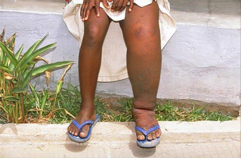 Dünyadaki en ilginç hastalıklar