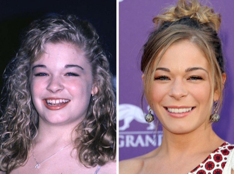 Ünlülerin değişen gülüşleri 