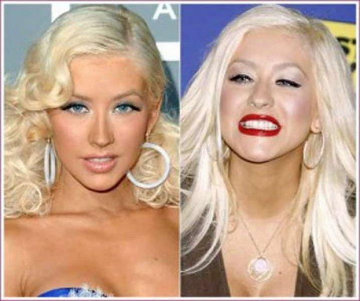 Ünlülerin estetik ameliyatı sonrası büyük değişimi 