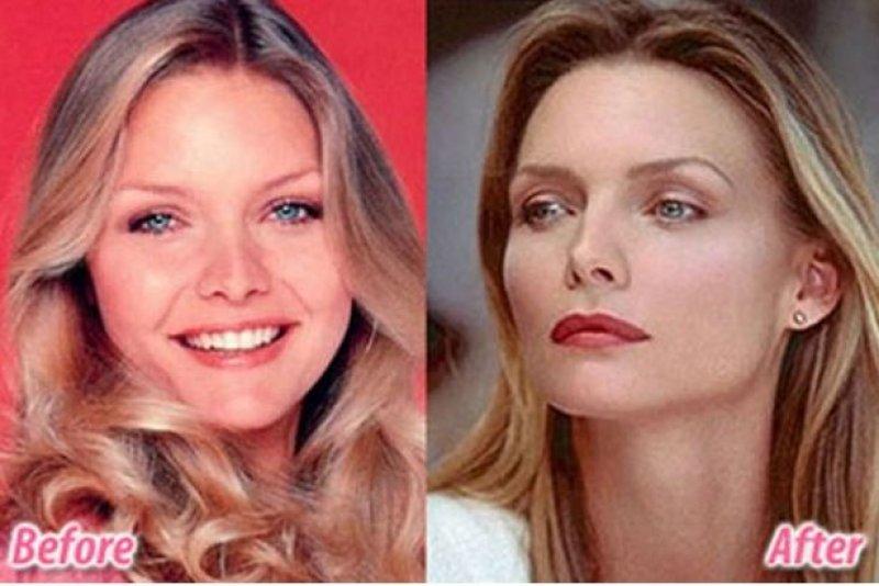 Ünlülerin estetik ameliyatı sonrası büyük değişimi 