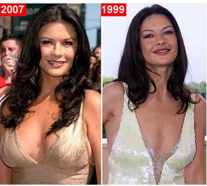 Ünlülerin estetik ameliyatı sonrası büyük değişimi 