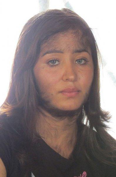 Hipertrikoz hastası aile belgesel oluyor 