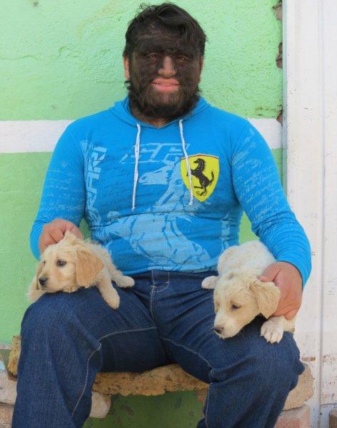 Hipertrikoz hastası aile belgesel oluyor 