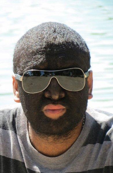 Hipertrikoz hastası aile belgesel oluyor 