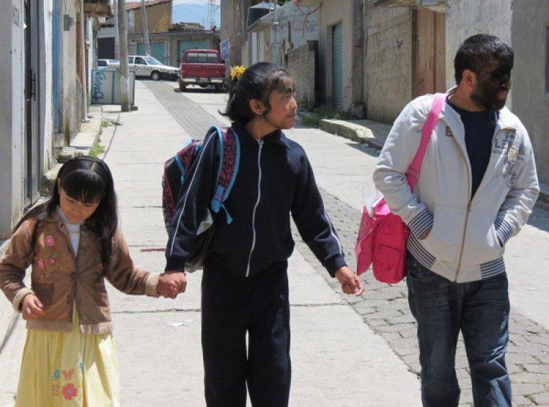 Hipertrikoz hastası aile belgesel oluyor 