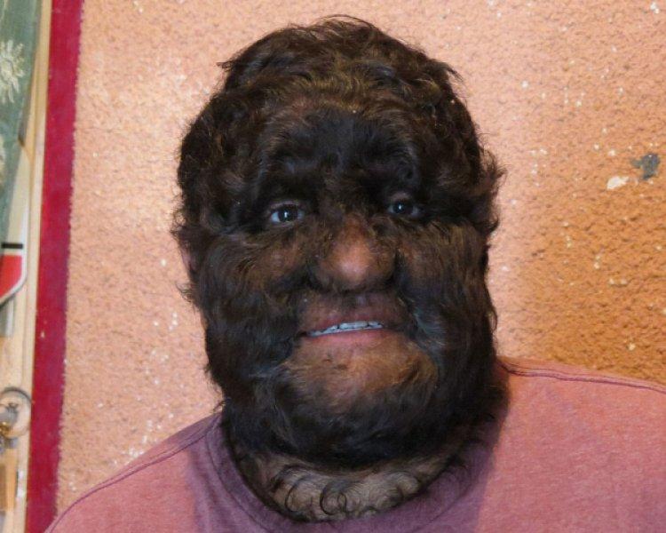 Hipertrikoz hastası aile belgesel oluyor 