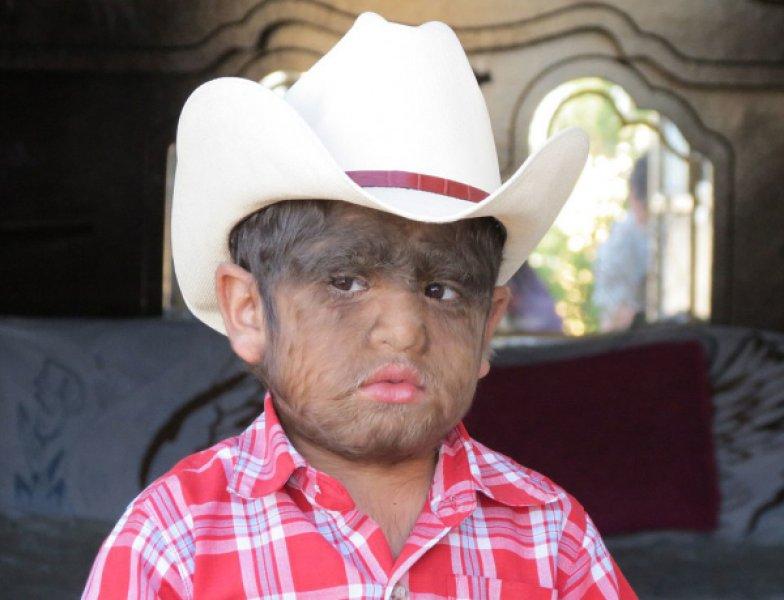 Hipertrikoz hastası aile belgesel oluyor 