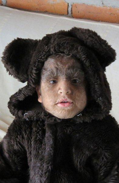 Hipertrikoz hastası aile belgesel oluyor 