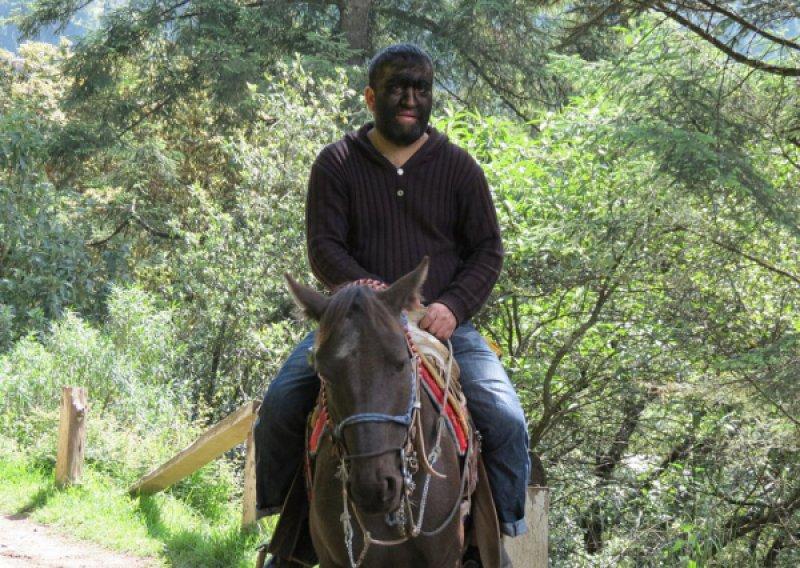 Hipertrikoz hastası aile belgesel oluyor 