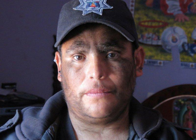 Hipertrikoz hastası aile belgesel oluyor 