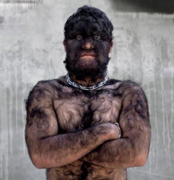 Hipertrikoz hastası aile belgesel oluyor 