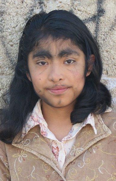 Hipertrikoz hastası aile belgesel oluyor 