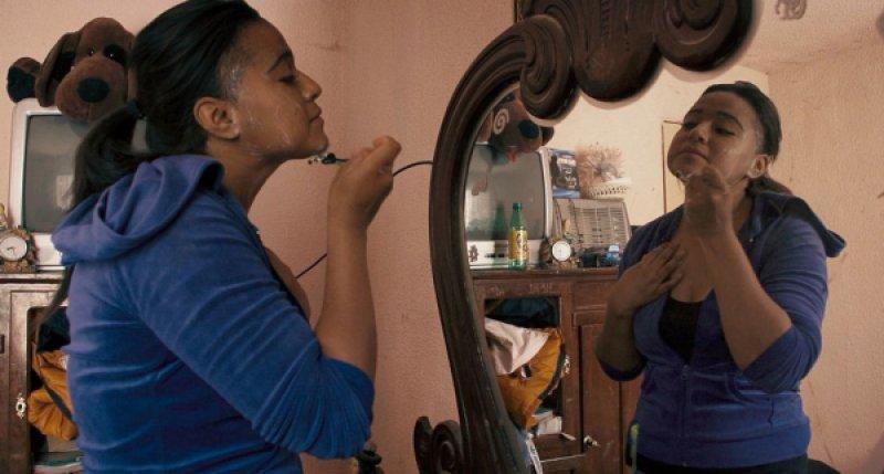 Hipertrikoz hastası aile belgesel oluyor 