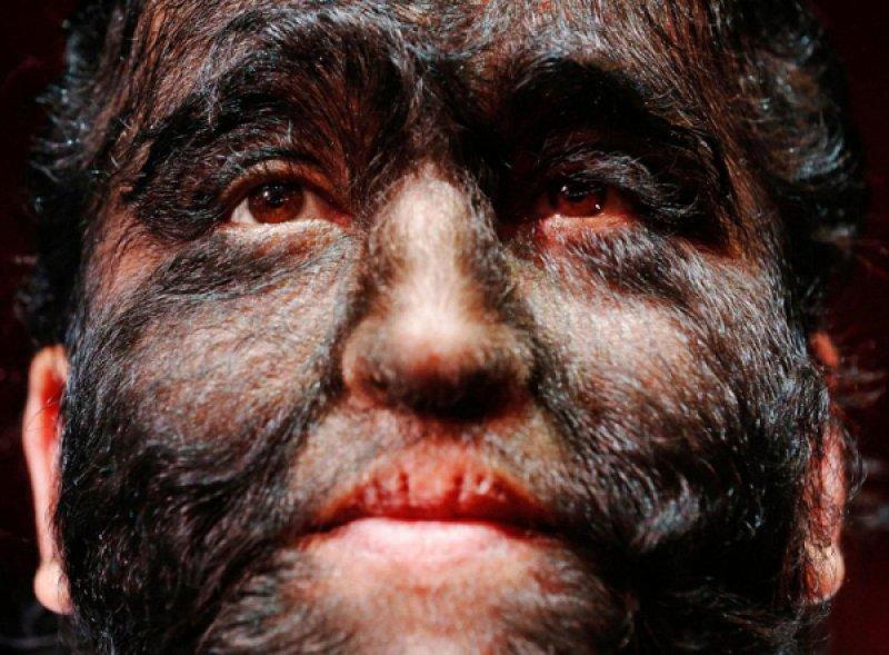 Hipertrikoz hastası aile belgesel oluyor 