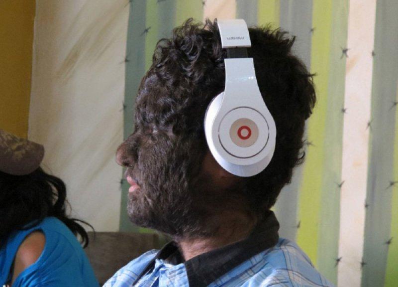 Hipertrikoz hastası aile belgesel oluyor 