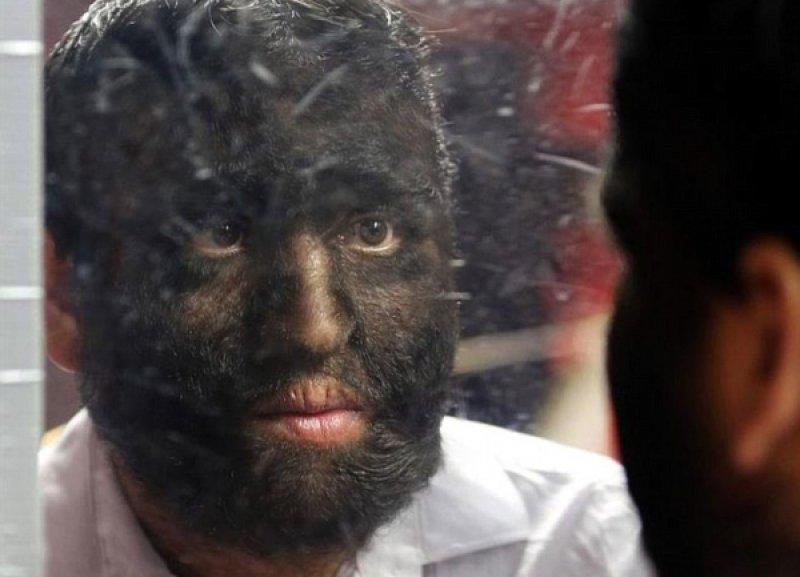 Hipertrikoz hastası aile belgesel oluyor 