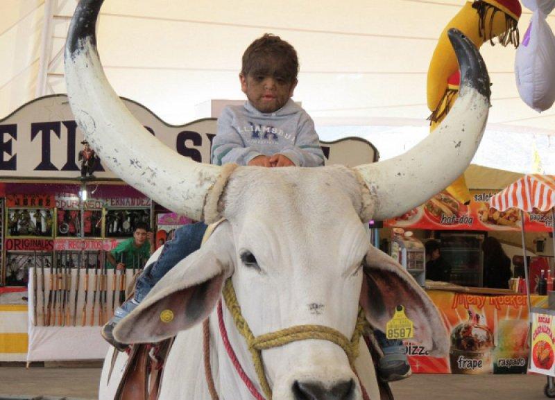 Hipertrikoz hastası aile belgesel oluyor 