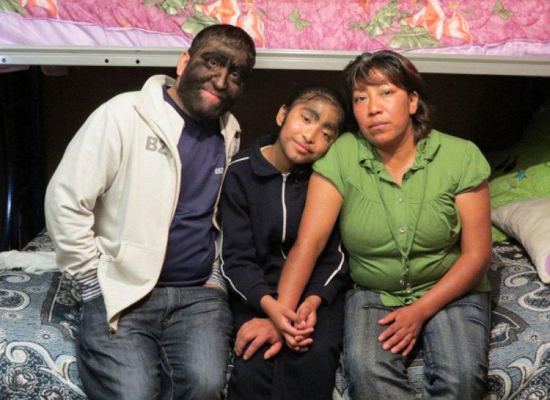 Hipertrikoz hastası aile belgesel oluyor 