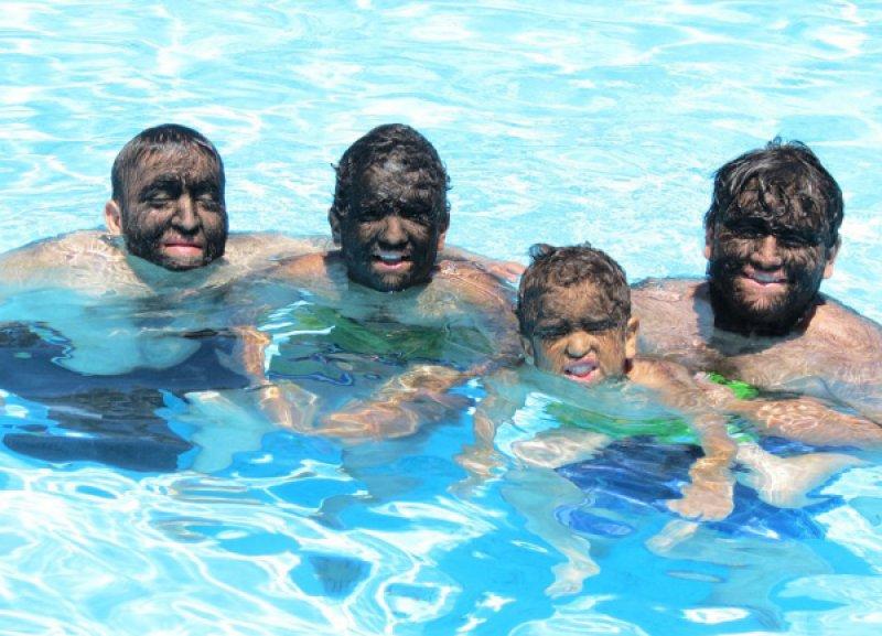 Hipertrikoz hastası aile belgesel oluyor 