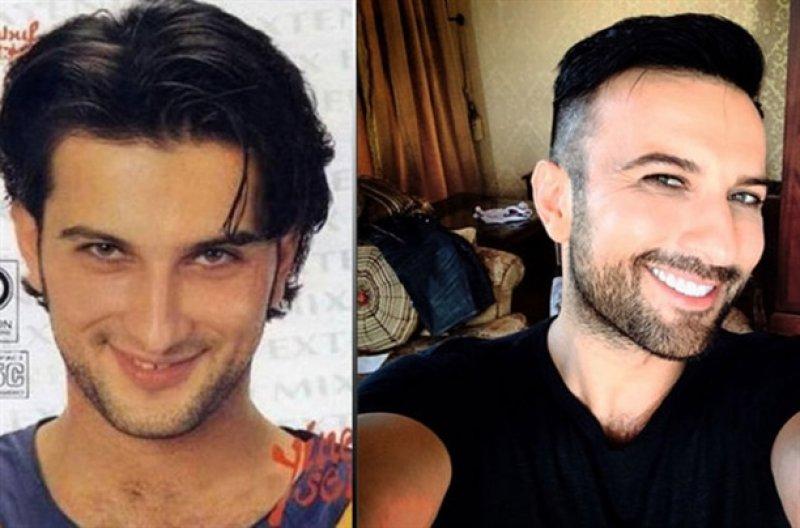 Gülümsemesini estetiğe borçlu ünlüler