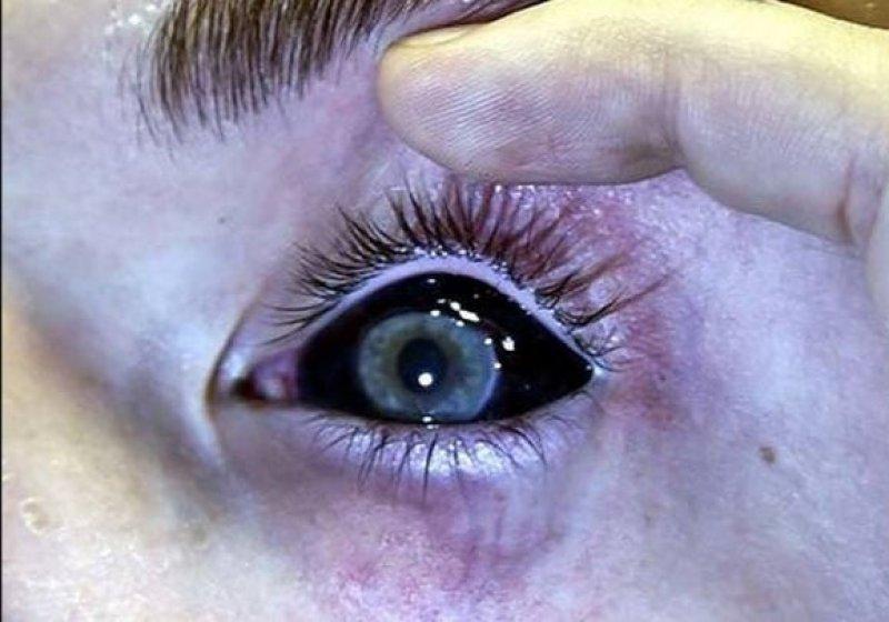 Göz akı dövmesi yasallaşıyor