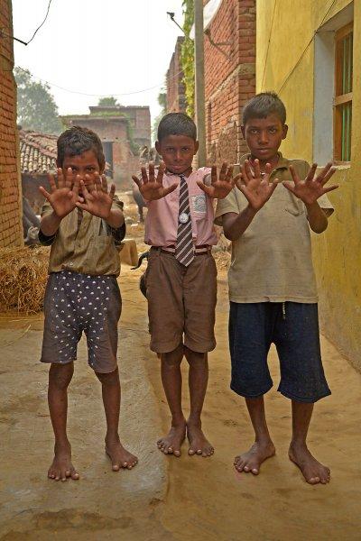 Hindistanlı Choudhary sülalesinin tamamı 6 parmaklı 