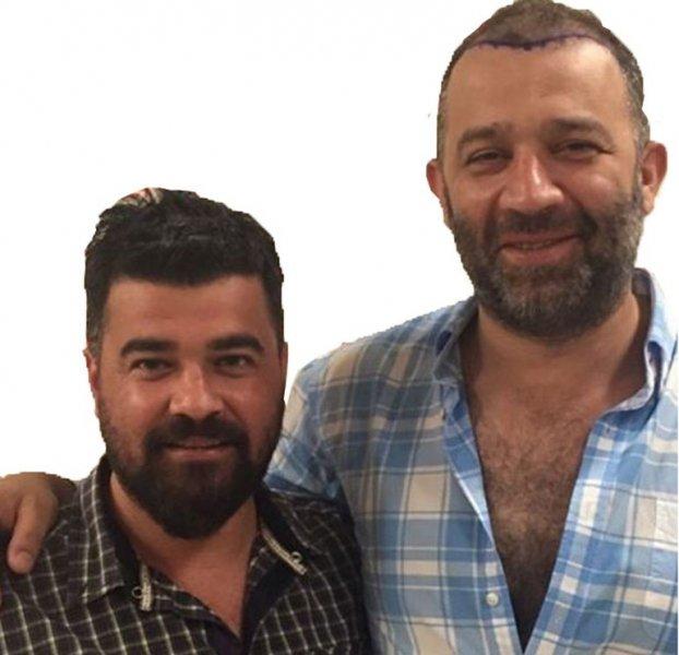  Saç ektiren ünlü isimler 