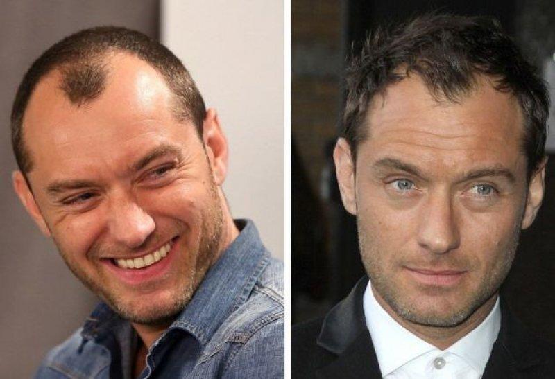  Saç ektiren ünlü isimler 