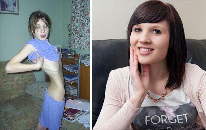 Anoreksiya hastalığını yenen insanlar