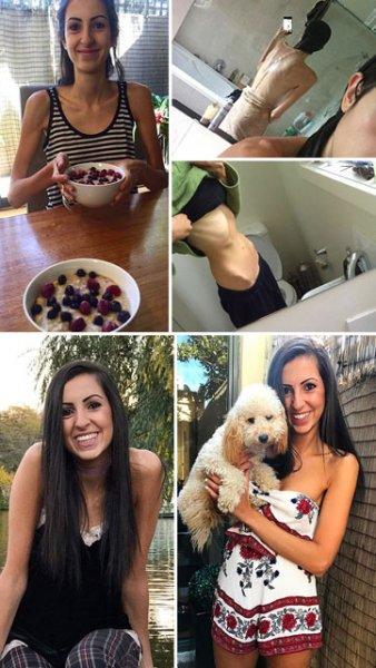 Anoreksiya hastalığını yenen insanlar