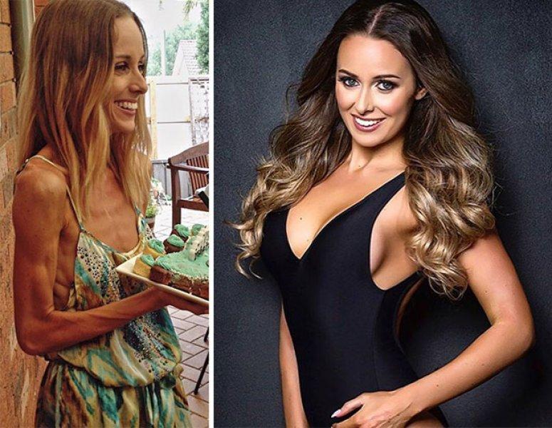 Anoreksiya hastalığını yenen insanlar