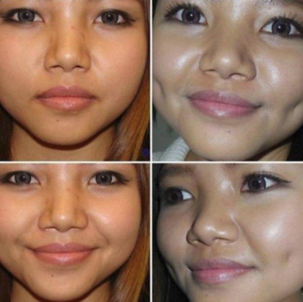 Yeni trend gamze estetiği 