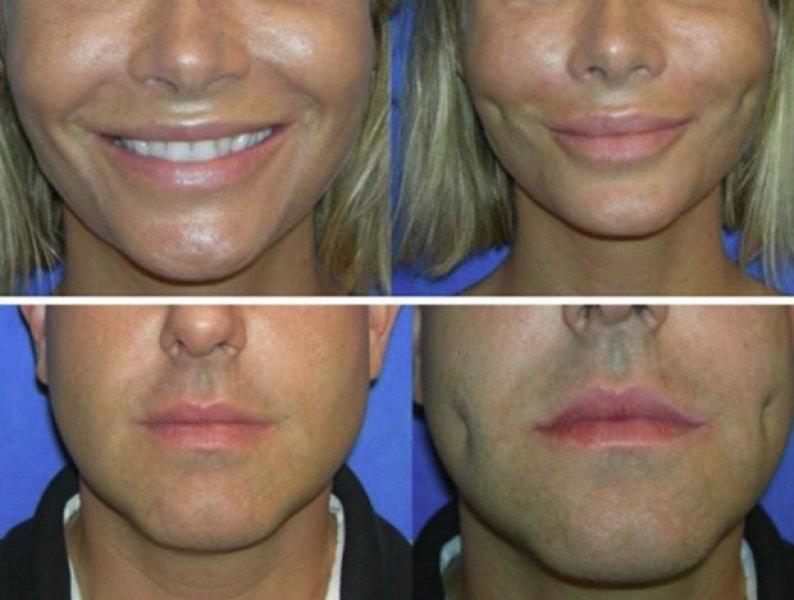 Yeni trend gamze estetiği 