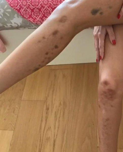 Şarkıcı Ayşe Akın geçirdiği anoreksiya hastalığını anlattı