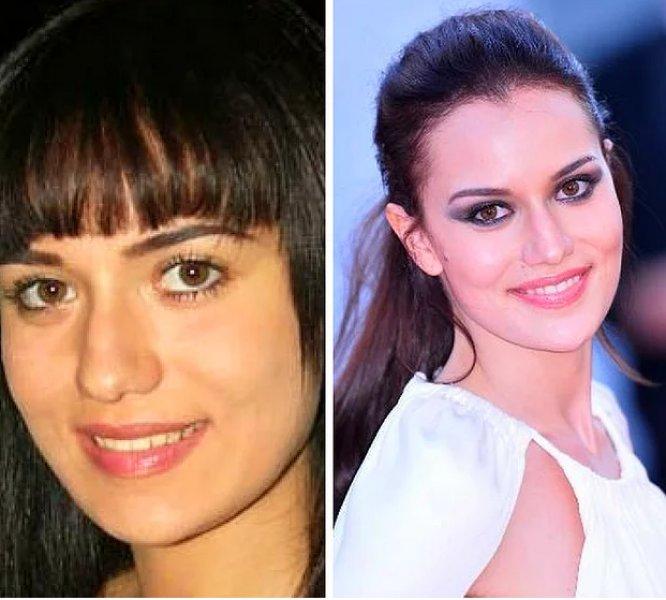 Estetik operasyon ile değişen ünlüler 