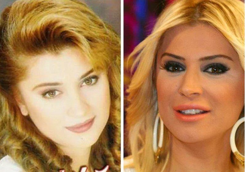 Estetik operasyon ile değişen ünlüler 