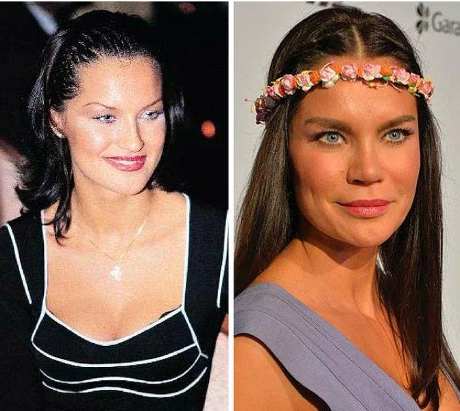 Estetik operasyon ile değişen ünlüler 