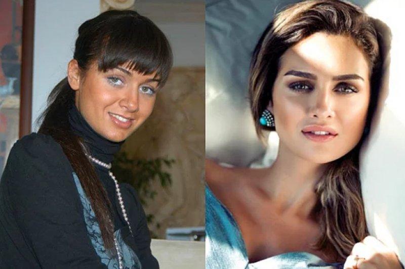 Estetik operasyon ile değişen ünlüler 