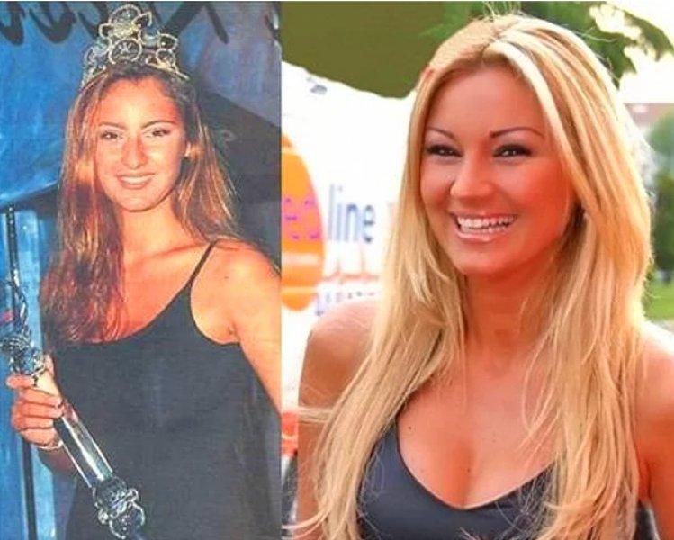 Estetik operasyon ile değişen ünlüler 