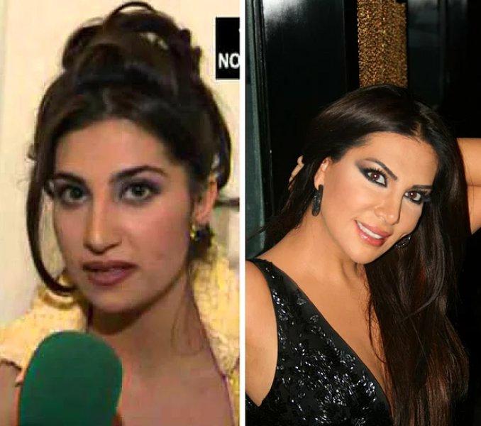 Estetik operasyon ile değişen ünlüler 