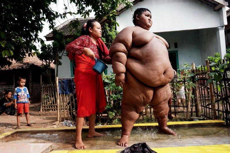 Dünyanın en şişman çocuğu 100 kilo verdi 