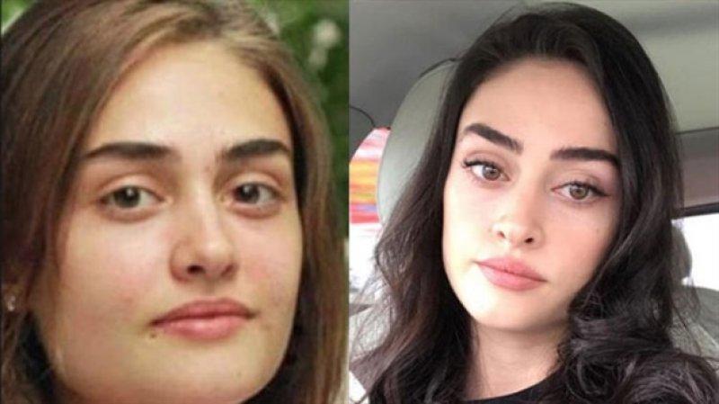 Esra Bilgiç'ten estetik açıklaması