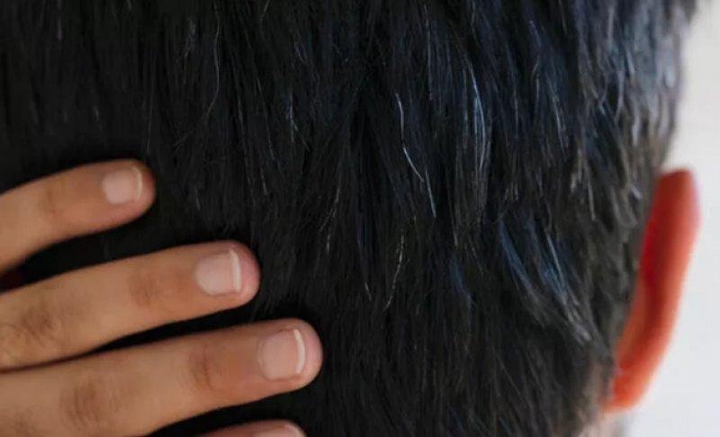 Erken yaşta saç beyazlatan nedenler ve alınacak önlemler