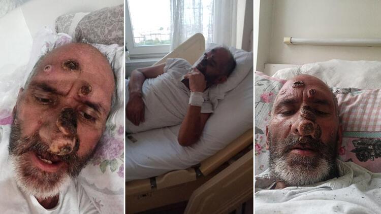 Sinek ısırdı, hayatı karardı! Yüzünü gören kafasını çeviriyor...