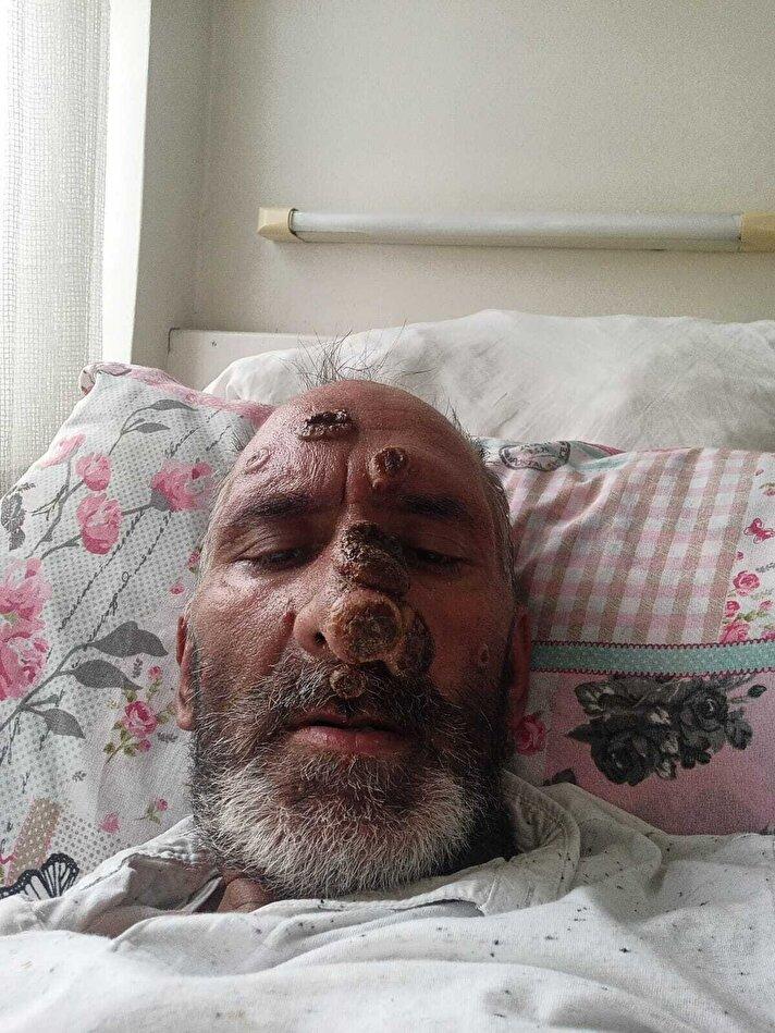 Sinek ısırdı, hayatı karardı! Yüzünü gören kafasını çeviriyor...