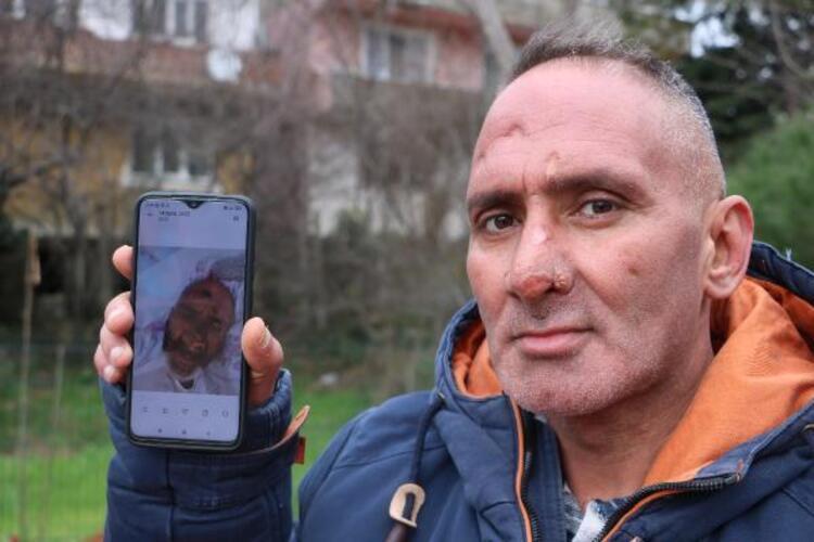 Sinek ısırdı, hayatı karardı! Yüzünü gören kafasını çeviriyor...