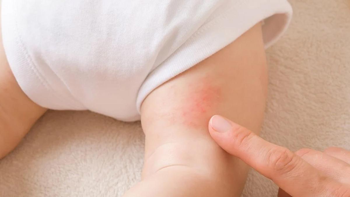 Hem yetişkin hem de bebekler için en iyi pişik kremleri ve fiyatları