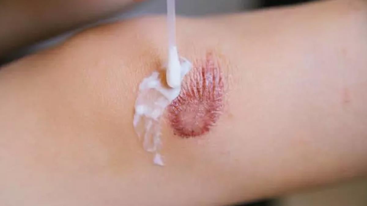 Reparil jel ne işe yarıyor? İşte Reparil jel kullanımı ve fiyatı 2024