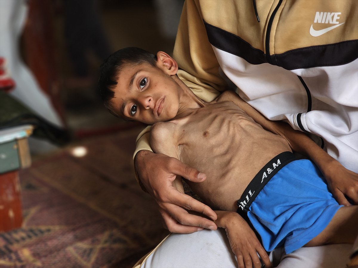 Gazze'de küçük Osama yaşam savaşı veriyor