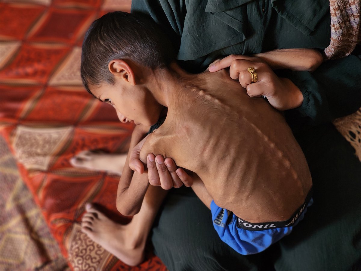 Gazze'de küçük Osama yaşam savaşı veriyor